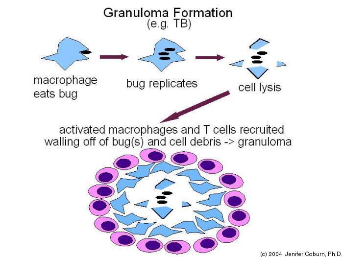 χρόνιος αντιγονικός ερεθισμός ενεργοποίηση μακροφάγων και Τ κυττάρων σχηματισμό κοκκιώματος (granuloma)