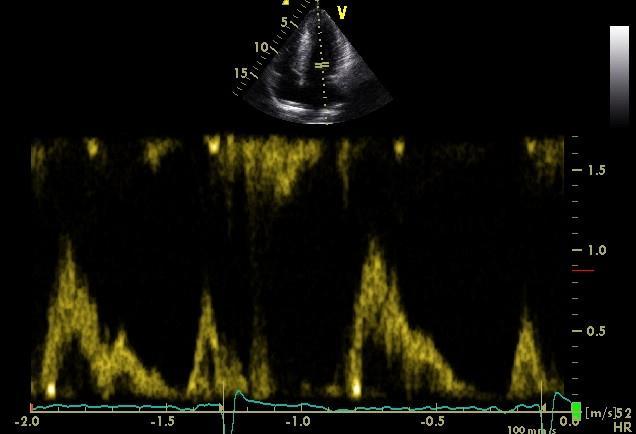 συνεχές Doppler και στην κορυφαία προβολή 5 κοιλοτήτων μετρήθηκε η μέγιστη στιγμιαία κλίση πίεσης (σε mmhg) στο χώρο