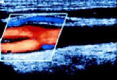 bulb. 2 Significant internal carotid stenosis in the region of an echogenic plaque indicated by color flow Doppler aliasing, with lighter shades of color indicating turbulence with increased