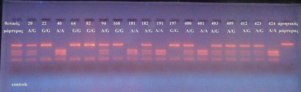 Στα δείγματα 22,64,82,168 και 197, παρατηρούνται 2 ζώνες, οπότε τα άτομα είναι ομόζυγα για το φυσιολογικό αλληλόμορφο, G.