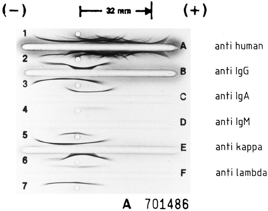Ανοσοηλεκτροφόρηση Έλεγχος των τριών ανοσοσφαιρινών IgG, IgA, IgM, καθώς και των ελαφριών τους αλυσίδων κ και λ, με τους αντίστοιχους αντιορούς Οι αύλακες περιέχουν αντισώματα έναντι ανθρώπινων