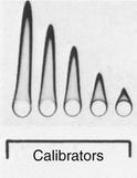 συγκέντρωσης του Ag. Rocket immunoelectrophoresis of human serum albumin. Patient samples were applied in duplicate.