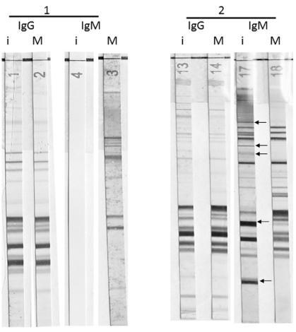 Ανοσοαποτύπωμα (Western Blot) Toxoplasma gondii Σύγκριση ανοσοαποτυπωμάτων IgG και IgM για ζεύγη ορών μητέρας (Μ) και βρέφους (i) κατά τη γέννηση 1.