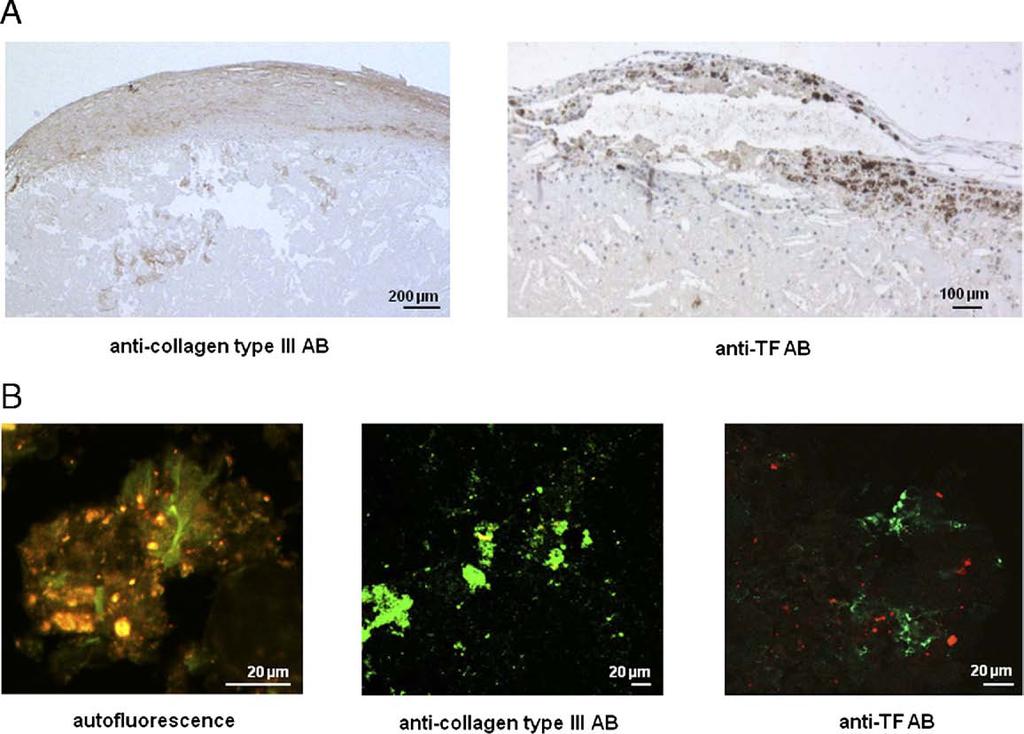 GPVI mediated platelet adhesion and aggregation onto plaque collagen occurred within 1 min.
