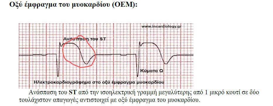 Ischemia or non-st elevation myocardial infarctions may manifest as ST