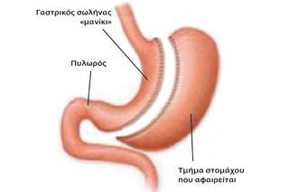 επιπλοκές, καθώς και σε ασθενείς με υπέρταση και η καρδιακή νόσο.