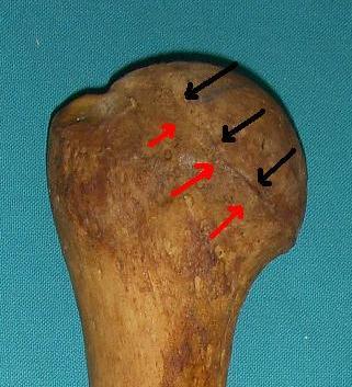 Εικ 13. Ο ανατομικός αυχένας και το αρθρικό χείλος απεικονίζονται με ερυθρά και μαύρα βέλη αντίστοιχα.