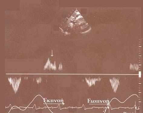 Εικόνα 10. Αιμορραγική περικαρδιακή συλλογή και επιπωματισμός. Κατά την εκπνοή, η φυσιολογική ροή στις ηπατικές φλέβες εξαφανίζεται, ενώ επικρατούν αντίστροφα κύματα (βέλος).
