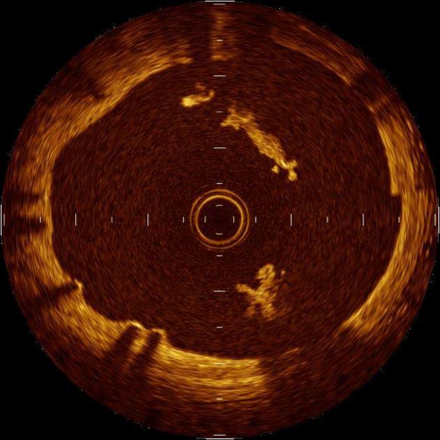 Βλάβη/stent Υποέκπτυξη +++