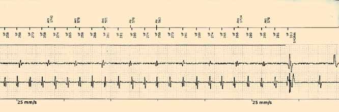 κοιλιακής μαρμαρυγής, VS = κοιλιακή αίσθηση, VT1 = αίσθηση κοιλιακής ταχυκαρδίας 1,