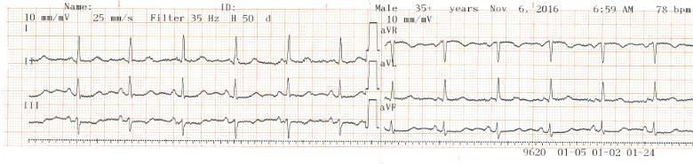ECG