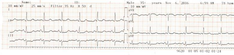 ECG