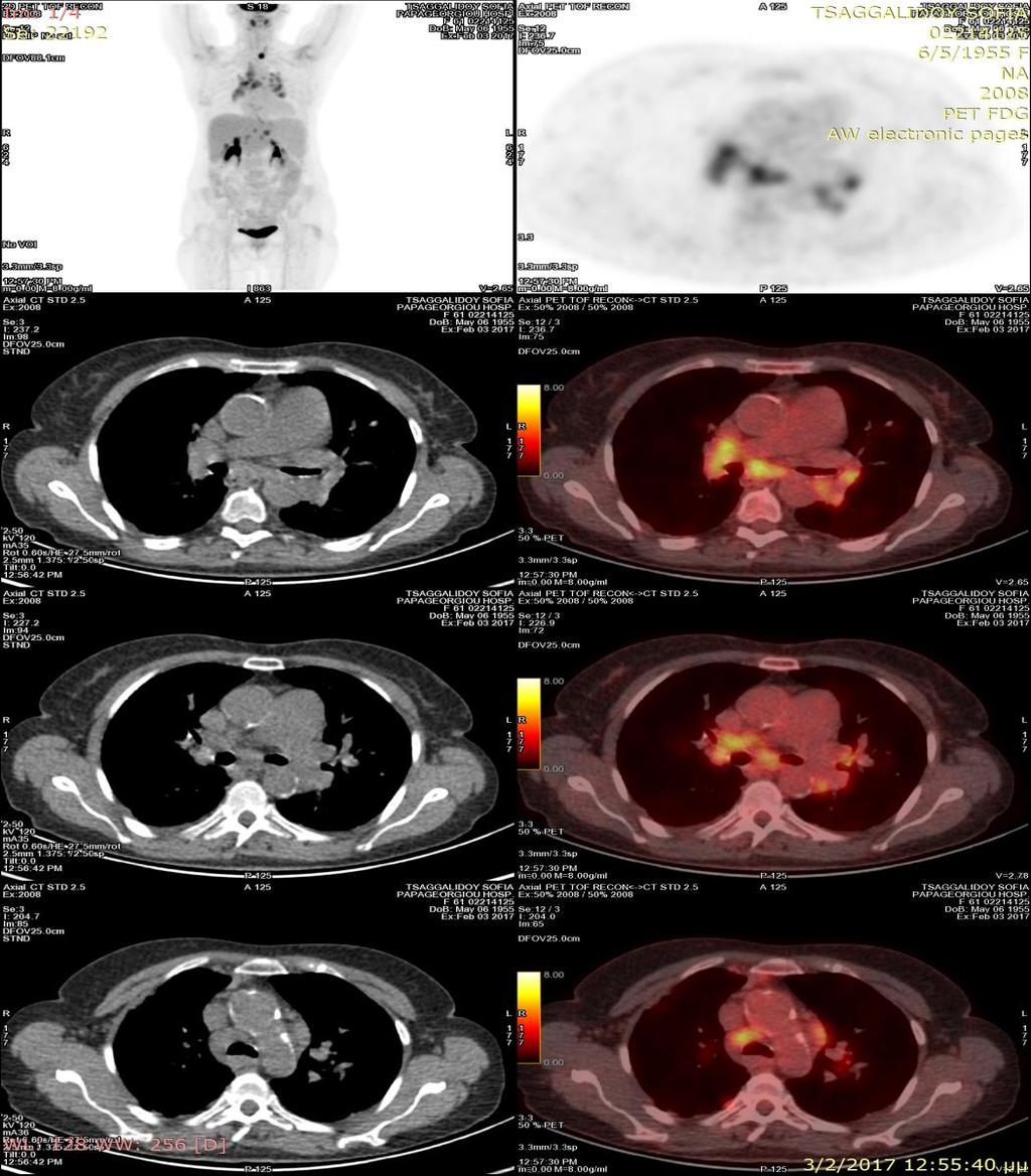 PET CT