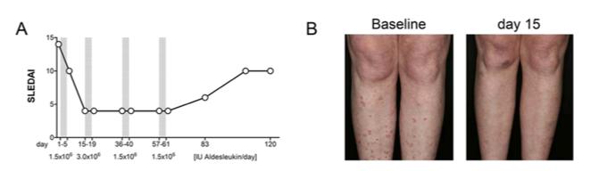 IL 2 and T regs in human SLE