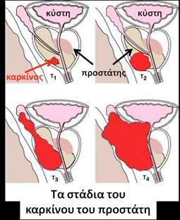 Εντόπιση Περιφερική ζώνη (75-80%). Κεντρική ζώνη (15%). Μεταβατική ζώνη (5-10%).