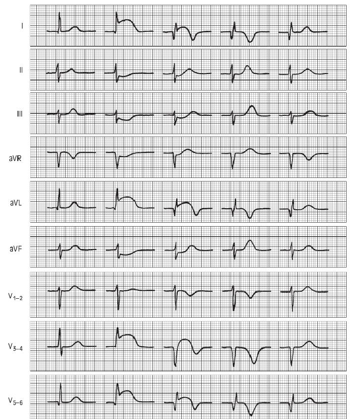 Έμφραγμα του μυοκαρδίου-ηκγ ευρήματα Φυσιολογική πρώιμη όψιμη προχωρημένη πολύ προχωρημένη