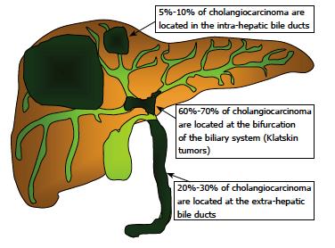 Χολαγγειοκαρκίνωμα 5-10% ενδοηπατικό 60-70% πυλαίο
