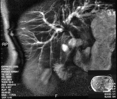 MRCP: Πυλαίο