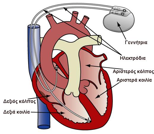 Αδαμαντία Ροδάκη διαταράσσουν τη συχνότητα με την οποία πάλλεται η καρδιά. Πρόκειται για μια μικρή συσκευή που λειτουργεί με μπαταρία.