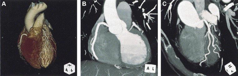 CT-STAT: Coronary computed Tomography in the