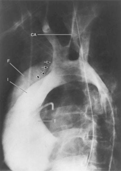 ΑΓΓΕΙΟΓΡΑΦΙΑ- ΙΑΓΝΩΣΗ ΙΑΧΩΡΙΣΜΟΥ direct angiographic signs, including visualization of two lumina or an intimal flap (considered diagnostic), indirect