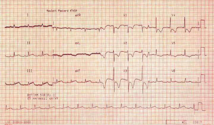 STEMI ST