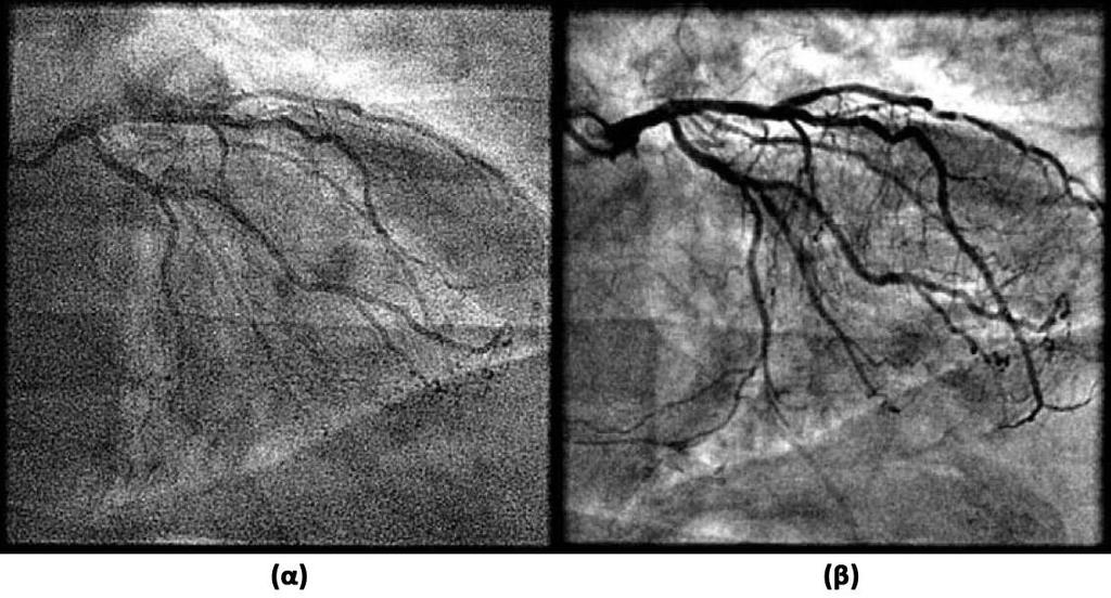 Ακτινολογικά συστήματα στην επεμβατική καρδιολογία Εικόνα 26. Σύγκριση μεμονωμένων εικόνων ακτινοσκόπησης (α) και CINE καταγραφής (β).
