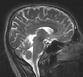 Εικόνα 2: MRI ανθρώπινου κρανίου. Πρόσφατα μονάδες παραγωγής ισχύος ξεκίνησαν να χρησιμοποιούν υπεραγώγιμους μετασχηματιστές και ελεγκτές της απώλειας ρεύματος που προκαλείται από τους κεραυνούς.