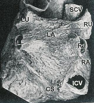 RA= δεξιός κόλπος, SCV=άνω κοίλη φλέβα, TS=εγκάρσιος κόλπος, LA=αριστερός κόλπος Σχήμα 2. Ανατομικό παρασκεύασμα του οπισθίου-κάτω τοιχώματος του αριστερού κόλπου.