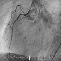 prestenting