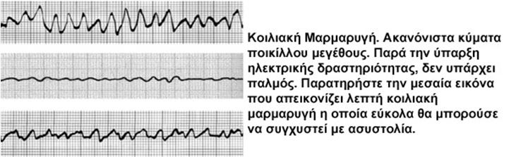 συμπιέσεις 100-120/λεπτό και συνεχείς εμφυσήσεις 10-12/λεπτό.