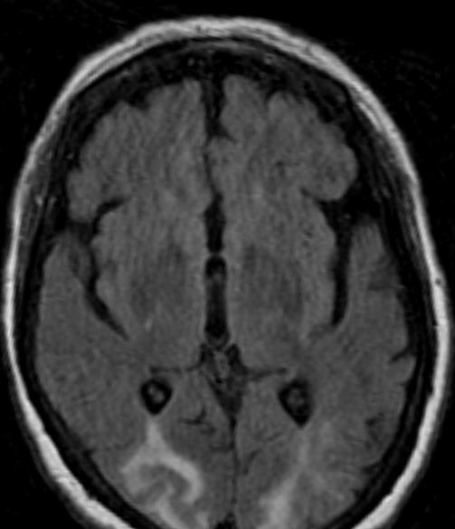 PRES PRES Posterior reversible encephalopathy syndrome.