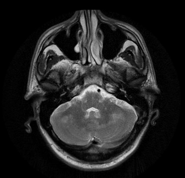 IRIS IRIS (Immune reconstitution inflammatory syndrome) «Φλεγμονώδες σύνδρομο ανοσιακής ανασύστασης» IRIS= παράδοξη επιδείνωση κλινική/απεικονιστική φλεγμονώδους φύσης Σε ασθενείς με AIDS