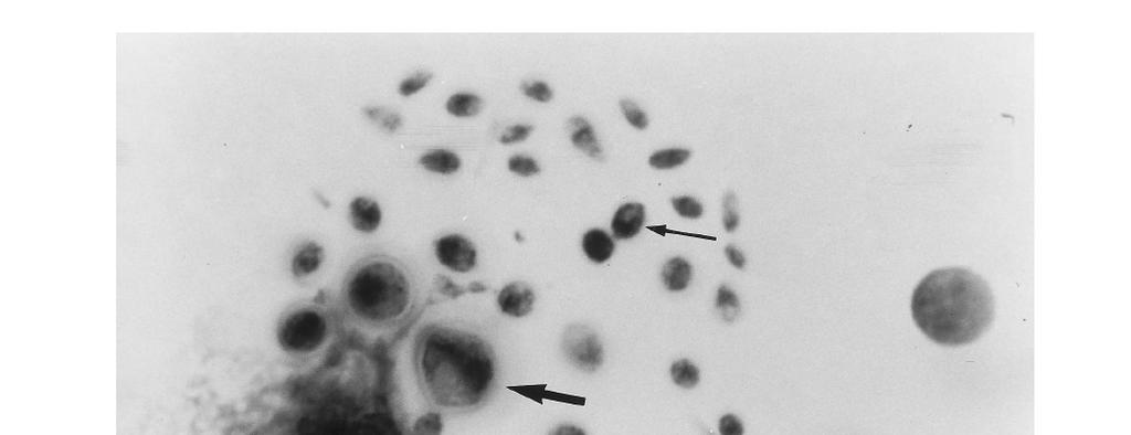 Central Nervous System Pneumocystosis in AIDS: Antemortem Diagnosis and