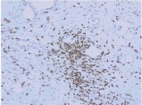 Inflammation and thermal heterogeneity in aortic stenosis Inflammatory CD3 infiltrates in AVS Association of inflammatory and neovascularization factors with temperature