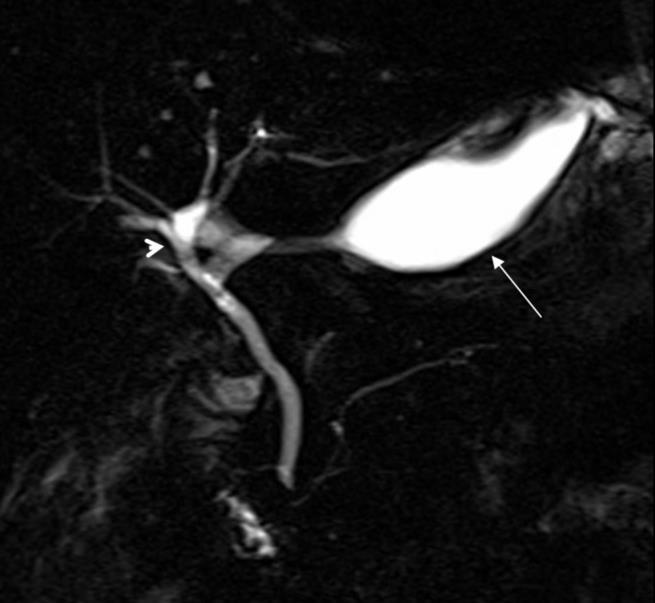 MRCP Χόλωμα ηπατογαστικού συνδέσμου διαδυγή από πλάγια CBD N.S.