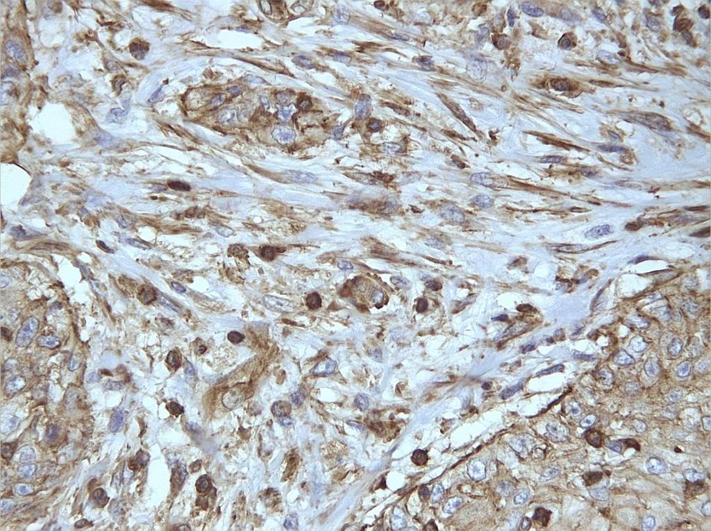 ΧΡΗΣΤΟΣ Π. ΜΑΓΟΠΟΥΛΟΣ Εικόνα 21. Ήπια έως μέτρια κυτταροπλασματική (κυρίως) και μεμβρανική (λιγότερο) ανοσοϊστοχημική χρώση του υποδοχέα CCR7 στα καρκινικά κύτταρα του μεταστατικού λεμφαδένα.