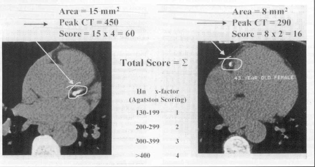 Agatston score Σε κάθε εγκάρσια τομή μετράται το Εμβαδόν (σε mm2) και η Πυκνότητα (σε HU) της ασβέστωσης προκύπτει μια τιμή
