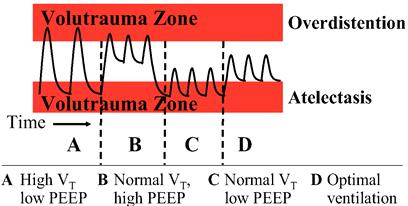 AIM Strana 19 Trigger PEEP 2-4 l/s FiO 2 40% 5 cmh 2 O PEEP - positive end-expiratory pressure tlak na konci výdychu počas UPV nad hodnotou atmosferického tlaku, vytvárajúci FRC, brániacu vzniku