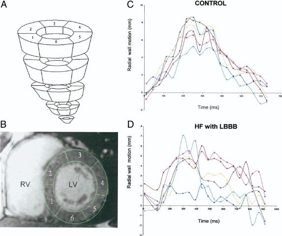 Myocardial Wall Motion J Am