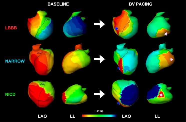 Propagation Mapping ECG Activation