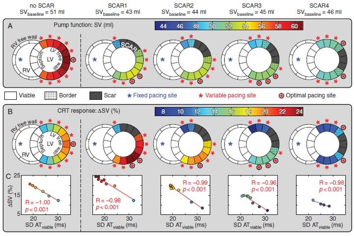 Effects of CRT on SV and resynchronization of