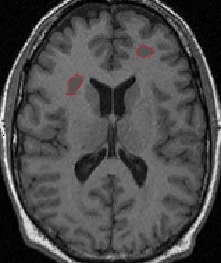 MRI Atlas παραμόρφωση MRI ROIs