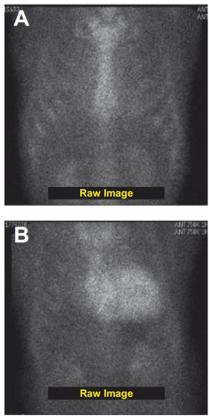 Tc-DPD ATTR Tc-PYP Rapezzi et al, J Am Coll Cardiol Img