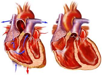 o In contrast with the 4 6% prevalence of diabetes in the community, the overrepresentation of diabetic patients in HF trials such as SOLVD