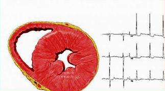 Left ventricular hypertrophy LVH Similarly Framingham was demonstrated in one-third of patients with Type II diabetes independent of blood pressure or ACE inhibitor use.