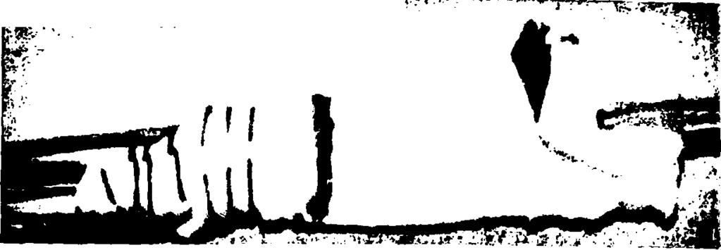 64 l Γ : τ. - TfVTT ;, ' --rf-' v» SW, "' ' ' ' ', ' ' * ' * Εικόνα 21. BPT μόσχευμα επιγονατιδικού τένοντα.