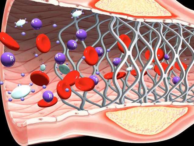 ΠΟΙΟ STENT ΘΑ