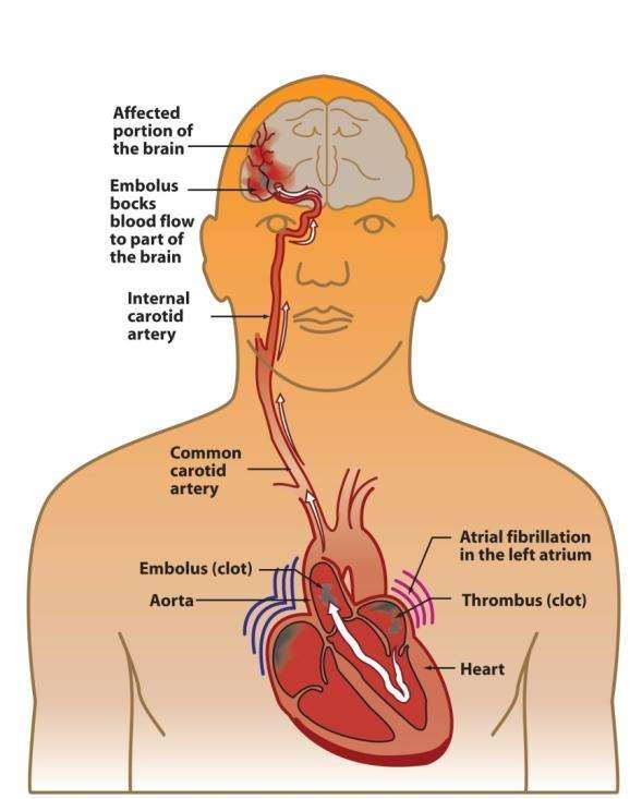 AF is an Independent Risk Factor for Stroke AF patients have a near 5-fold increased risk of stroke 1 1 in every 6 strokes occurs in a patient with AF 2 Ischemic stroke associated with AF is