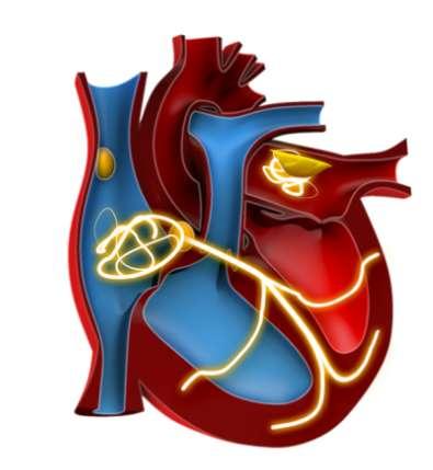 Current Treatment Strategies for AF Prevention of thrombo-embolism Rate